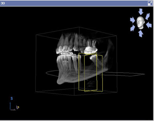 3D della bocca, importante per comprendere il riassorbimento osseo dovuto all'infiammazione causata dalla presenza di batteri parodontali