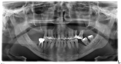 OPT o panoramica della arcate dentali - utile per rilevare la presenza di infezioni parodontali in corso